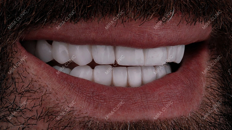BL2 shade and 23 zirconium crowns